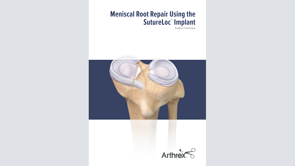 Meniscal Root Repair Using the SutureLoc™  Implant