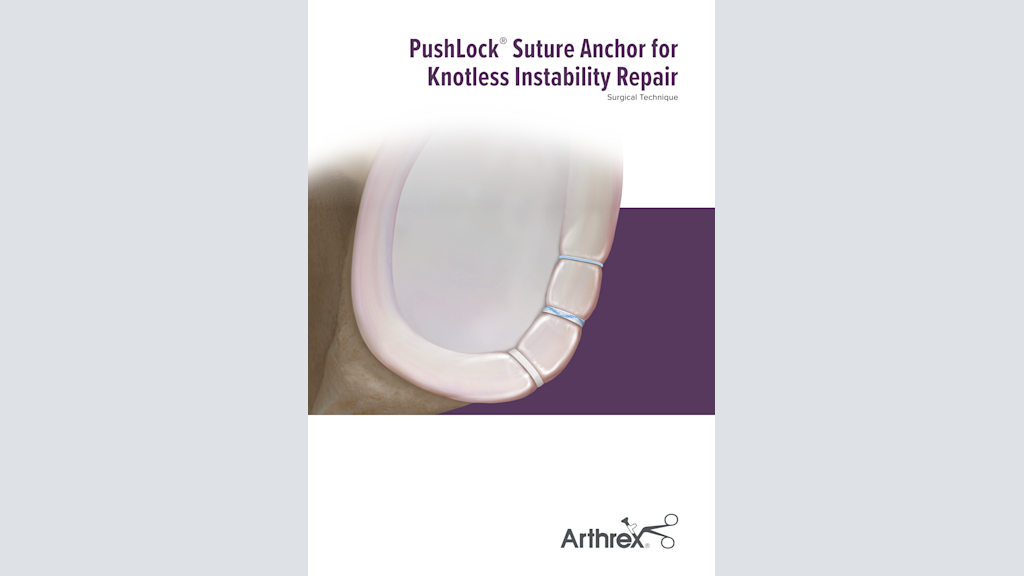 PushLock® Suture Anchor for Knotless Instability Repair