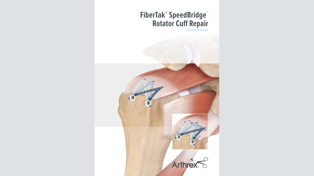 FiberTak® SpeedBridge™ Rotator Cuff Repair