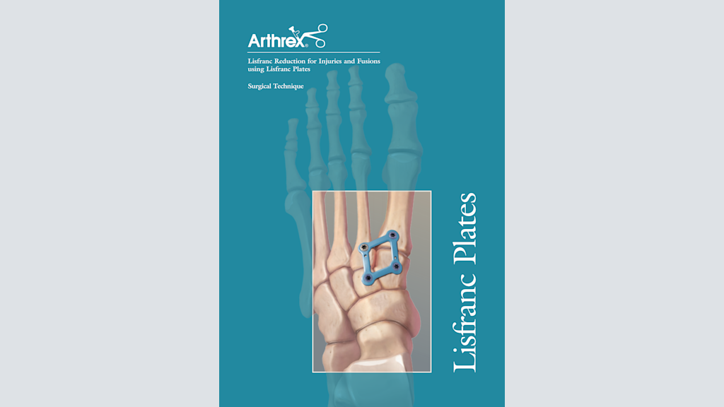 Lisfranc Reduction for Injuries and Fusions using Lisfranc Plates
