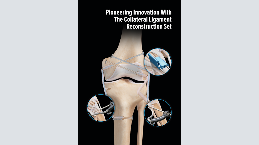 Pioneering Innovation with the Collateral Ligament Reconstruction Set