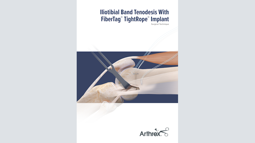 Iliotibial Band Tenodesis With FiberTag® TightRope® Implant