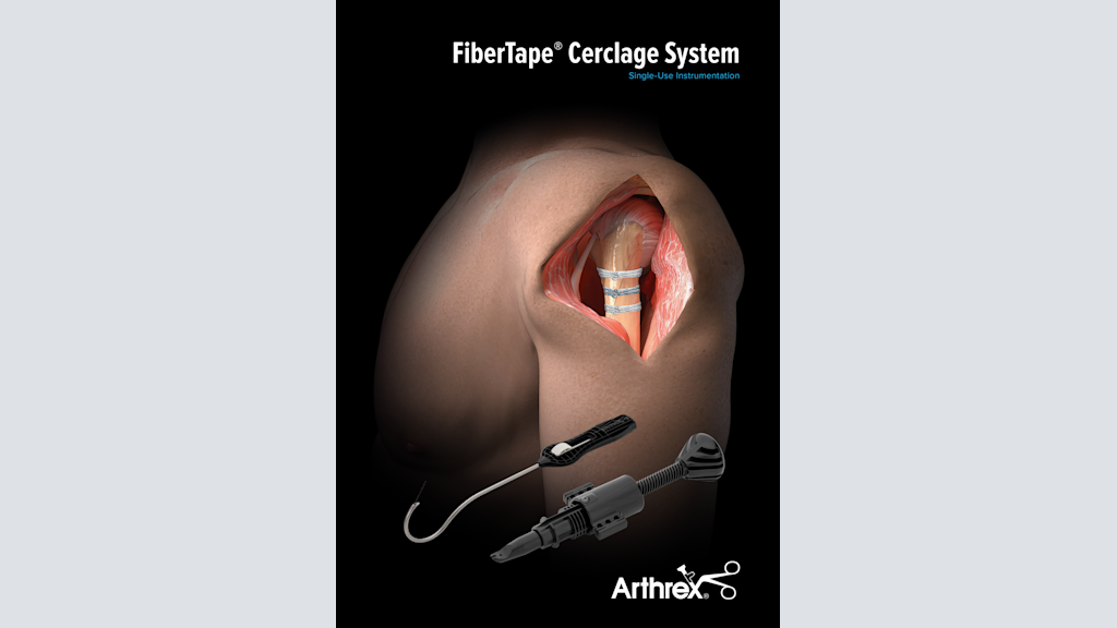 FiberTape® Cerclage System - Single-Use Instrumentation