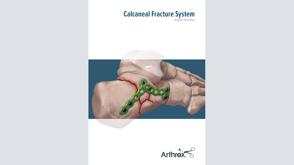 Calcaneal Fracture System