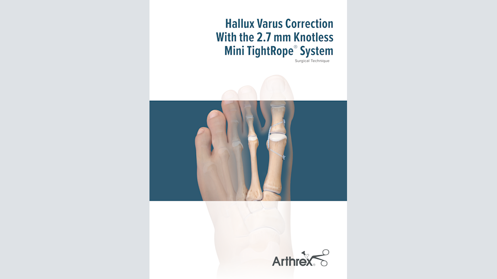 Hallux Varus Correction With the 2.7 mm Knotless Mini TightRope® System
