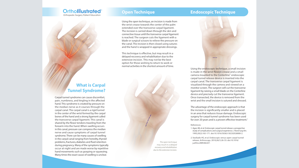 Carpal Tunnel Syndrome (CTS)