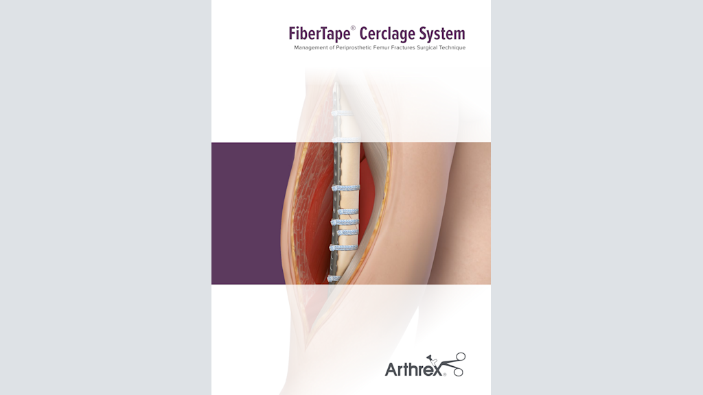 FiberTape® Cerclage System Management of Periprosthetic Femur Fractures Surgical Technique
