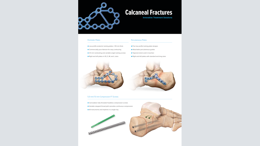 Calcaneal Fractures Innovative Treatment Solutions