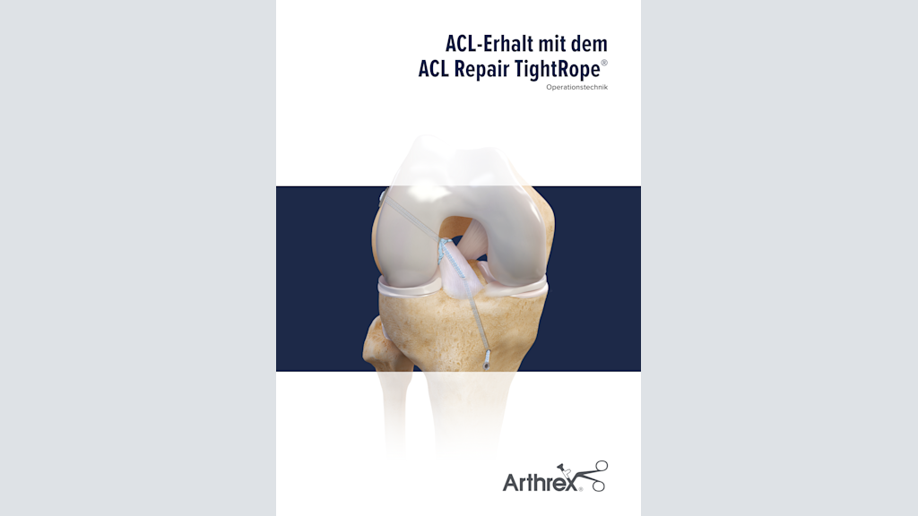 ACL-Erhalt mit dem ACL Repair TightRope®