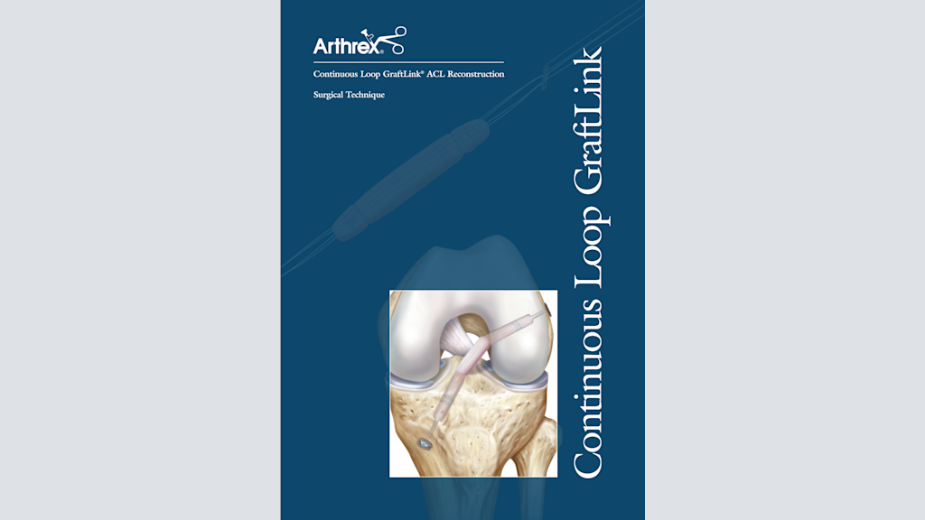 Continuous Loop GraftLink® ACL Reconstruction
