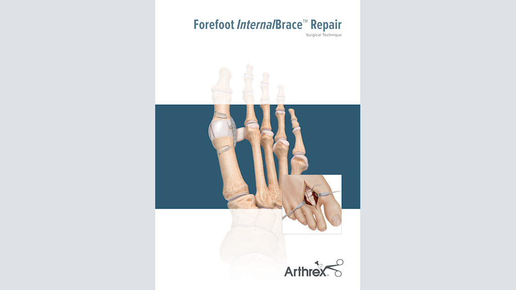 Forefoot InternalBrace™ Repair