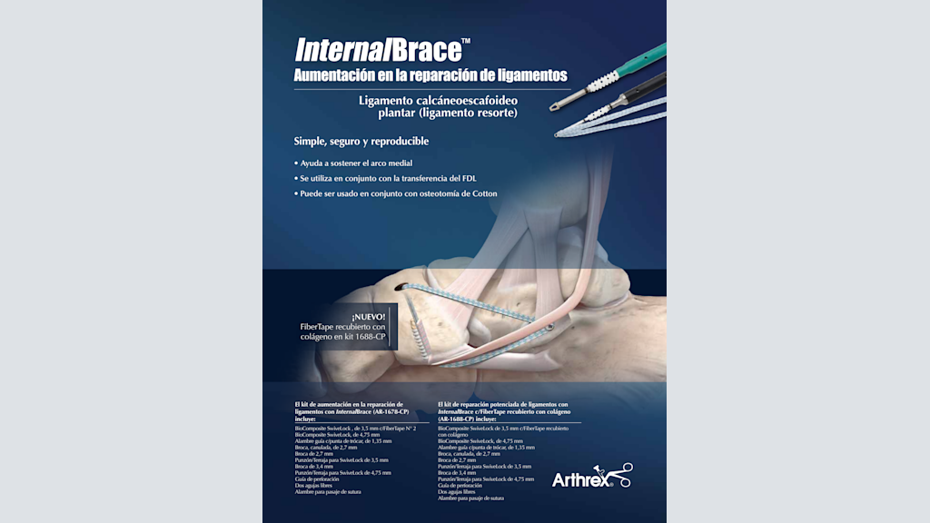 InternalBrace™ - Aumentación en la reparación de ligamentos