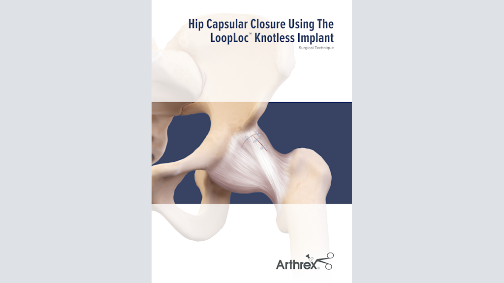 Hip Capsular Closure Using The LoopLoc™ Knotless Implant