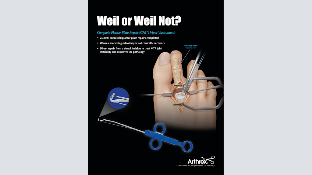 Weil or Weil Not? – Complete Plantar Plate Repair (CPR™) Viper™Instrument