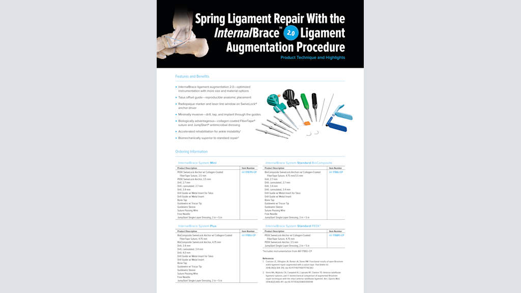 Spring Ligament Repair With the InternalBrace™ 2.0 Ligament Augmentation Procedure