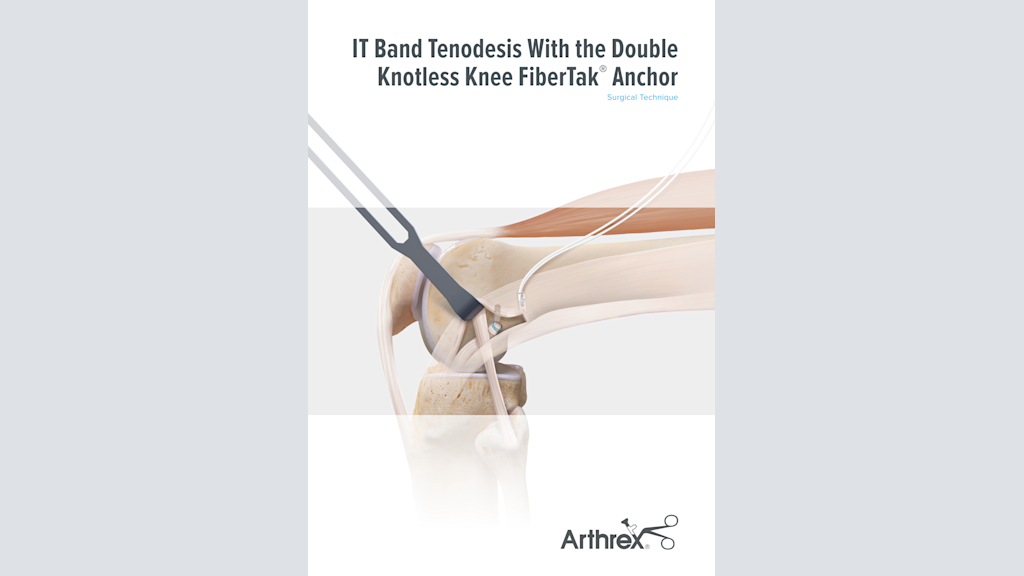IT Band Tenodesis With the Double-Knotless Knee FiberTak® Anchor
