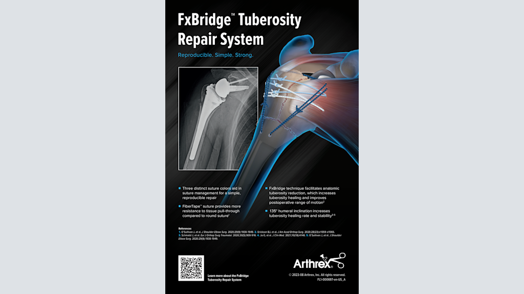 FxBridge™ Tuberosity Repair System