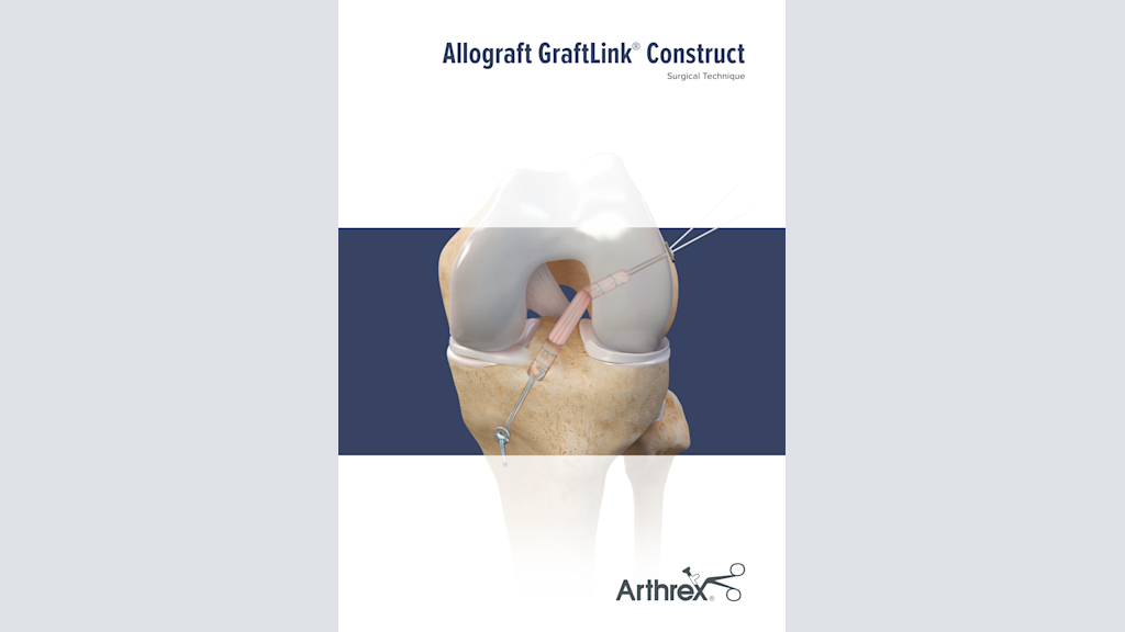 Allograft GraftLink® Construct
