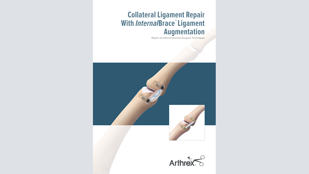 Collateral Ligament Repair With InternalBrace™ Ligament Augmentation