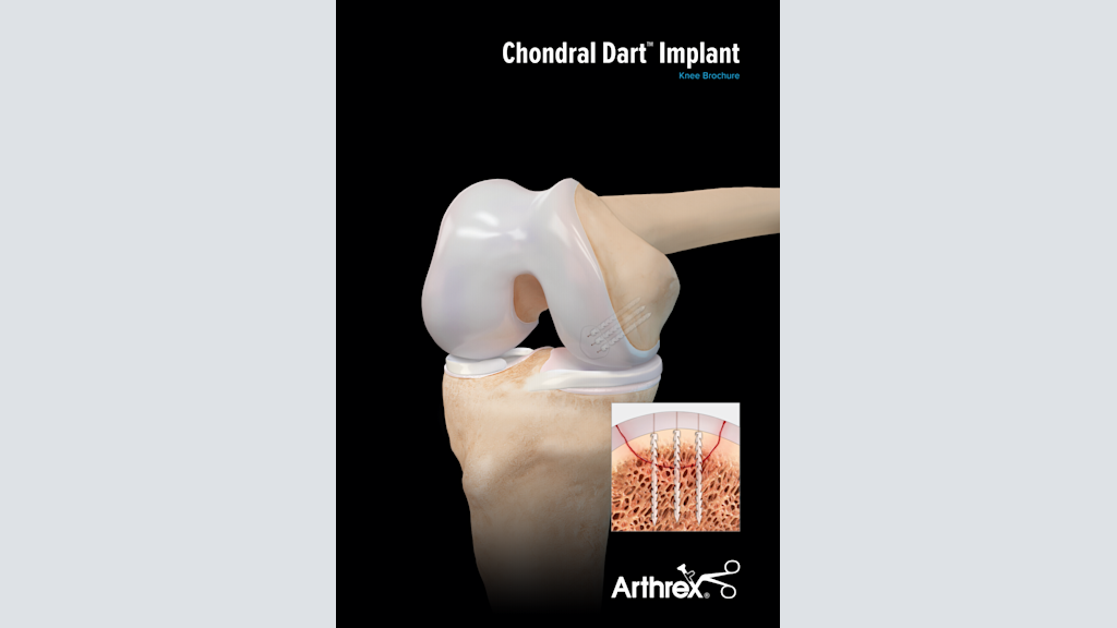 The Arthrex Chondral Dart™