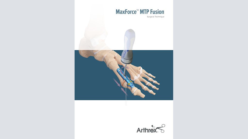MaxForce™ MTP Fusion