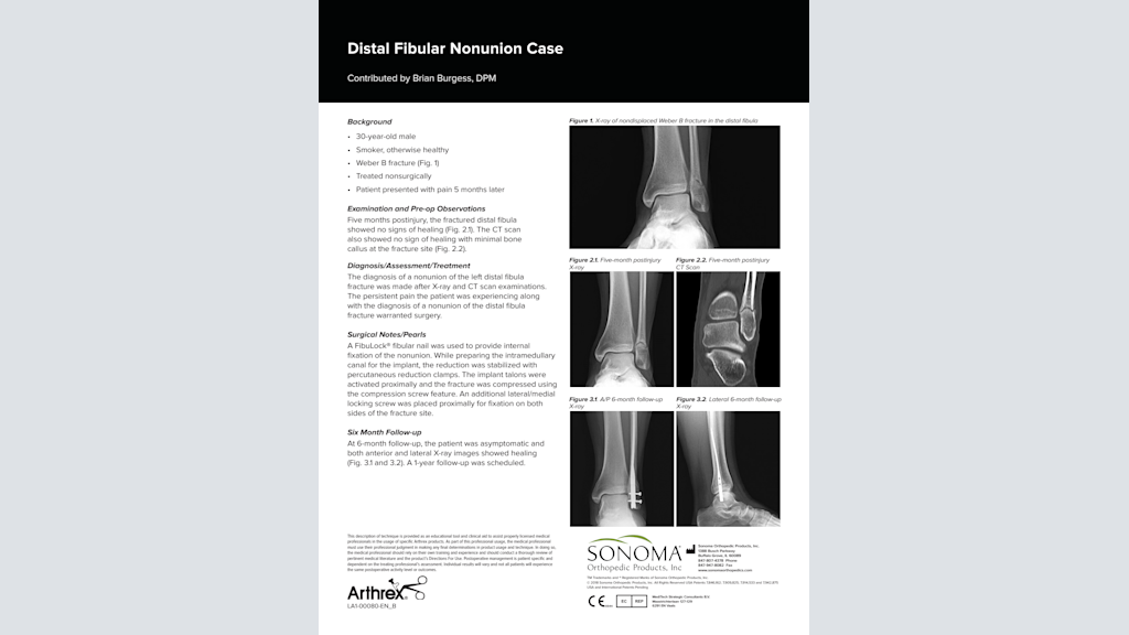 Distal Fibular Nonunion Case