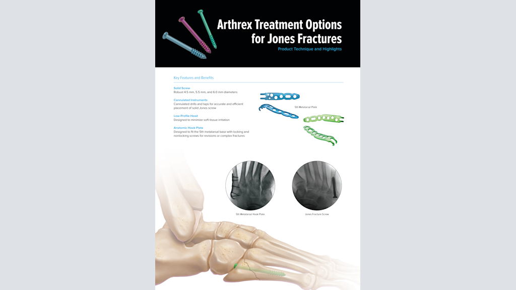 Arthrex Treatment Options for Jones Fractures