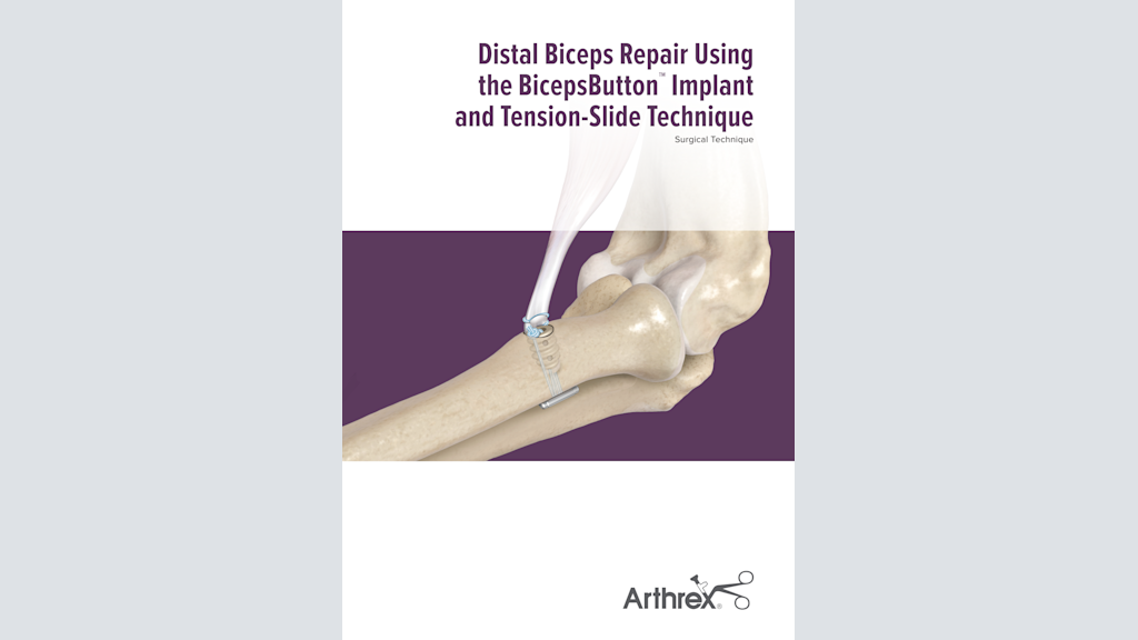 Distal Biceps™ Repair using the BicepsButton™ and Tension-Slide Technique