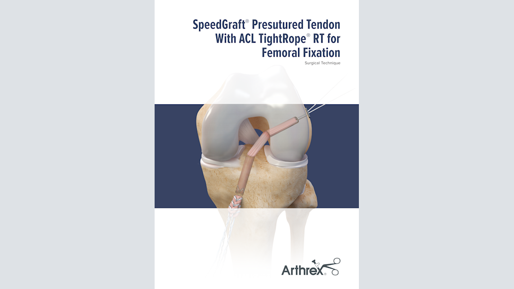 SpeedGraft® Presutured Tendon With ACL TightRope® RT for Femoral Fixation