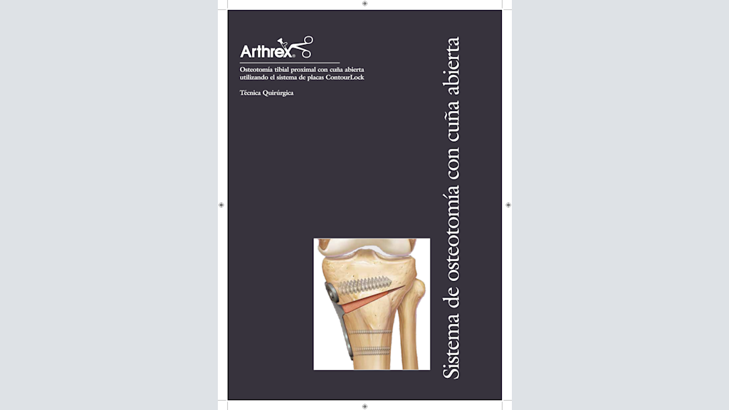 Osteotomía tibial proximal con cuña abierta utilizando el sistema de placas ContourLock