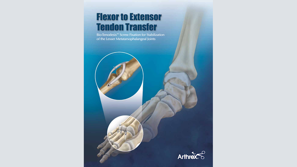 Flexor to Extensor Tendon Transfer - Bio-Tenodesis™ Screw Fixation for Stabilization of the Lesser Metatarsophalangeal Joints