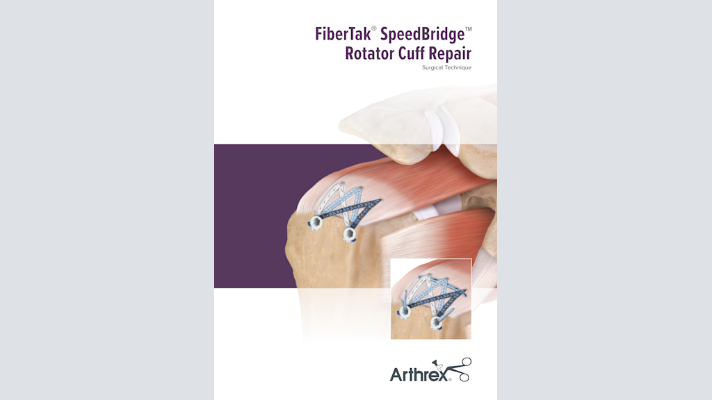 FiberTak® SpeedBridge™ Rotator Cuff Repair