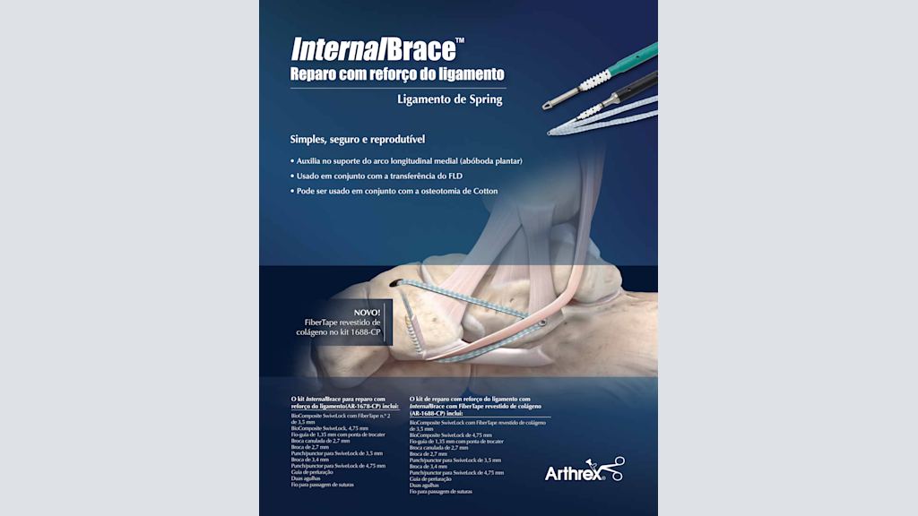 InternalBrace™ Reparo com reforço do ligamento - Ligamento Spring