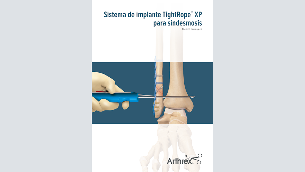 Sistema de implante TightRope® XP para sindesmosis