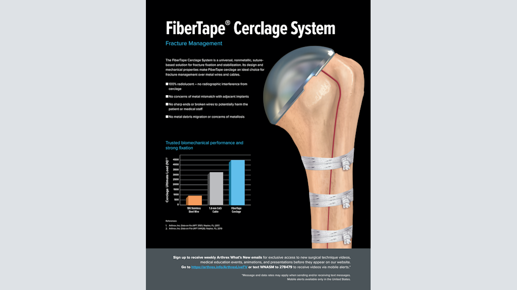 FiberTape® Cerclage System Fracture Management