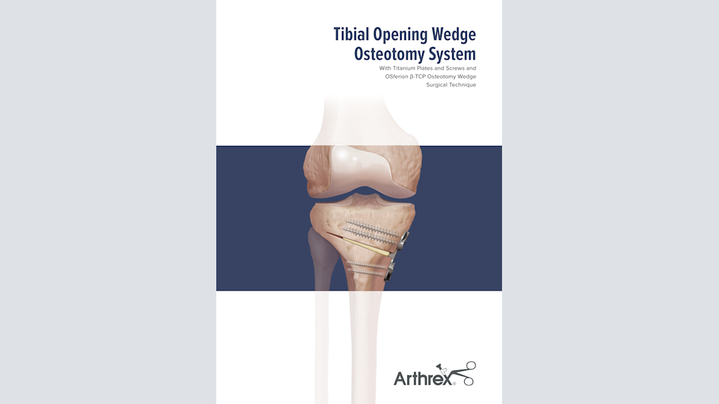 Tibial Opening Wedge Osteotomy System With Titanium Plates and Screws and OSferion β-TCP Osteotomy Wedge