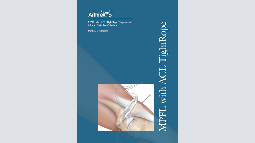 MPFL with ACL TightRope® Implant and 3.5 mm SwiveLock® Anchor
