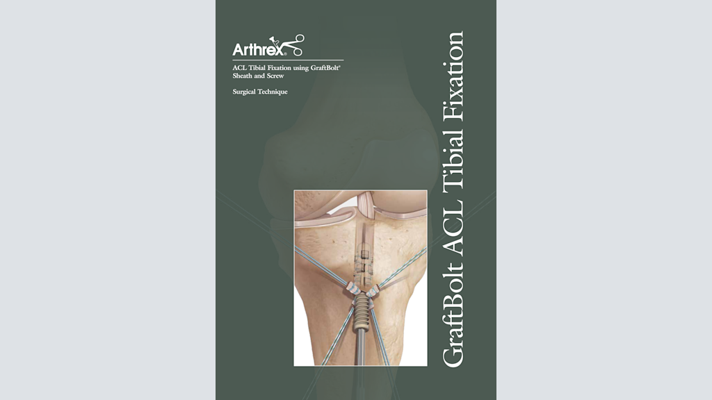 ACL Tibial Fixation using GraftBolt® Sheath and Screw