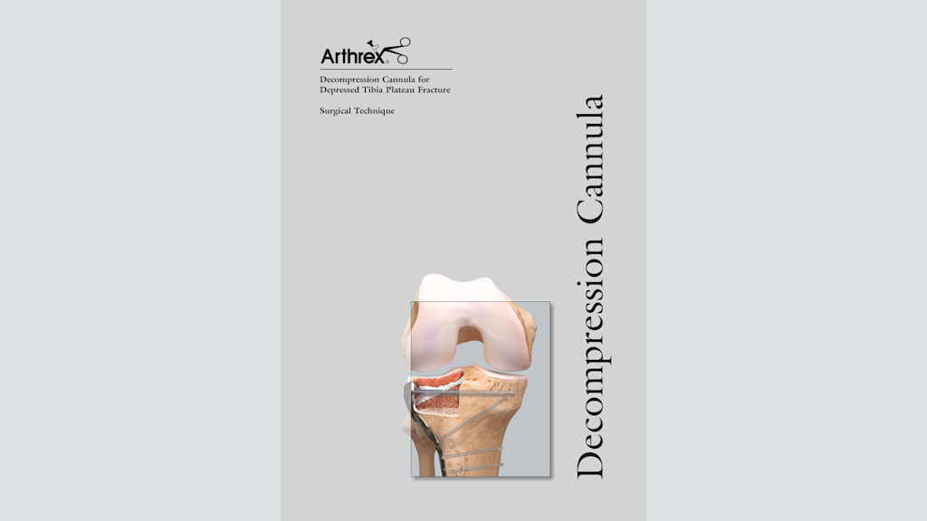 Decompression Cannula for Depressed Tibia Plateau Fracture