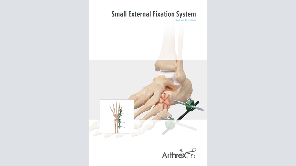 Small External Fixation System