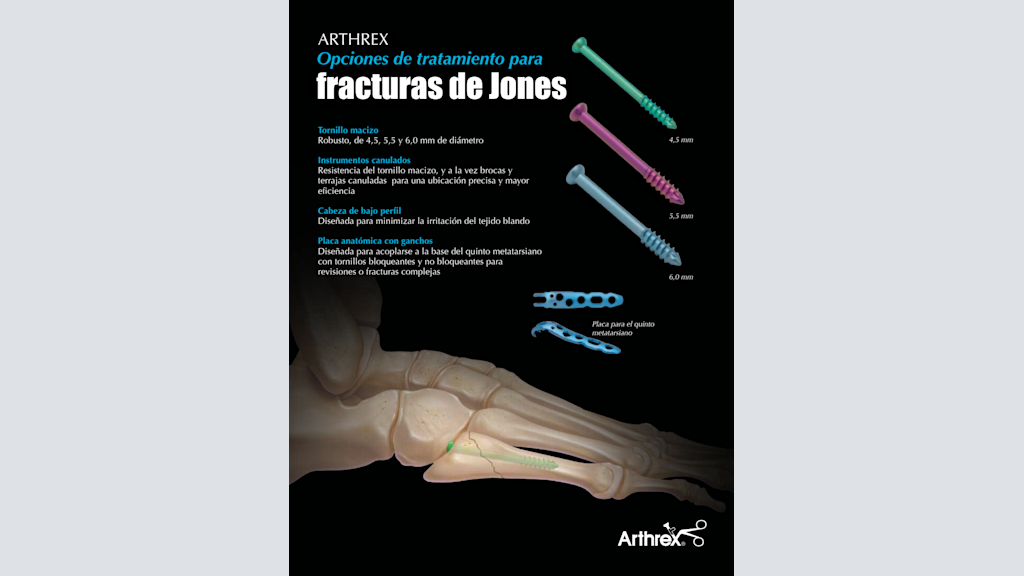 Opciones de tratamiento para fracturas de Jones