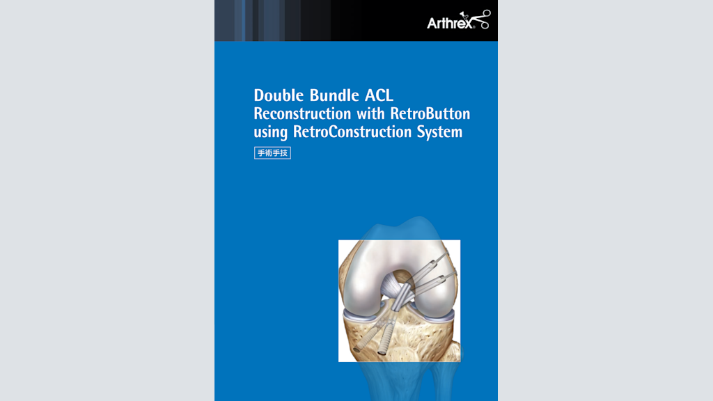 Double Bundle ACL Reconstruction with RetroButton using RetroConstruction System