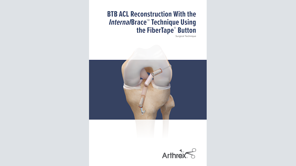 BTB ACL Reconstruction With the InternalBrace™ Technique Using the FiberTape® Button