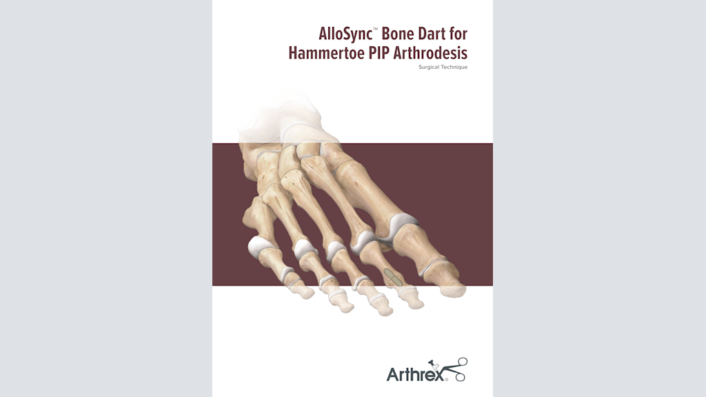 AlloSync™ Bone Dart for Hammertoe PIP Arthrodesis
