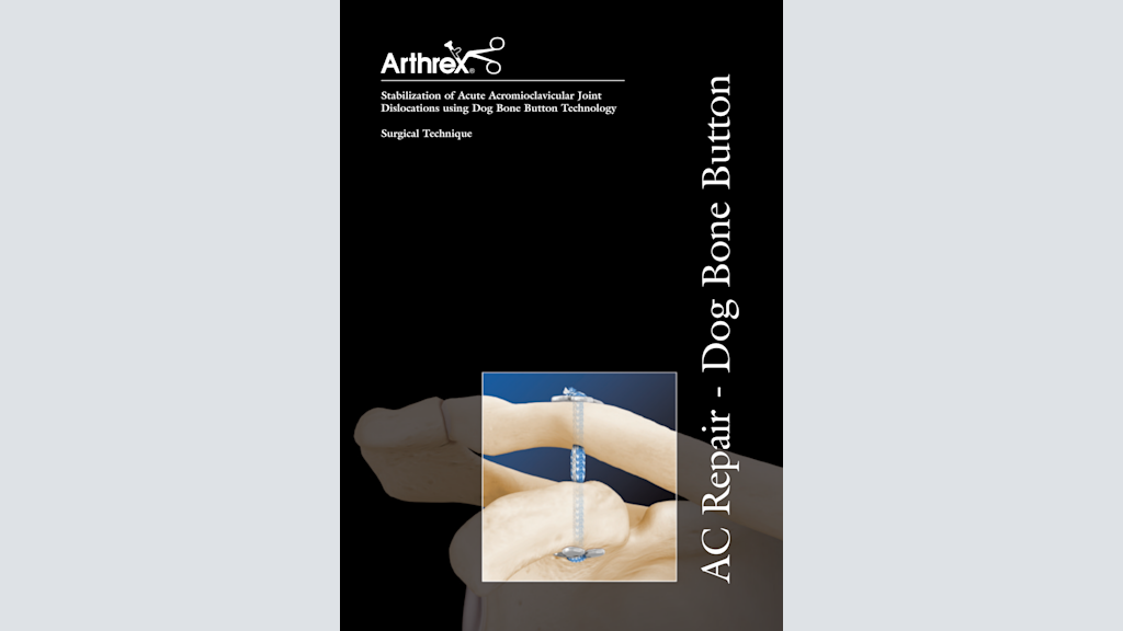 Stabilization of Acute Acromioclavicular Joint Dislocations using Dog Bone Button Technology