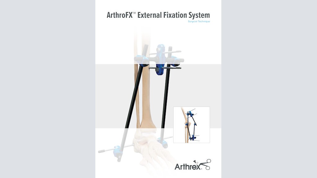 ArthroFX™ External Fixation System