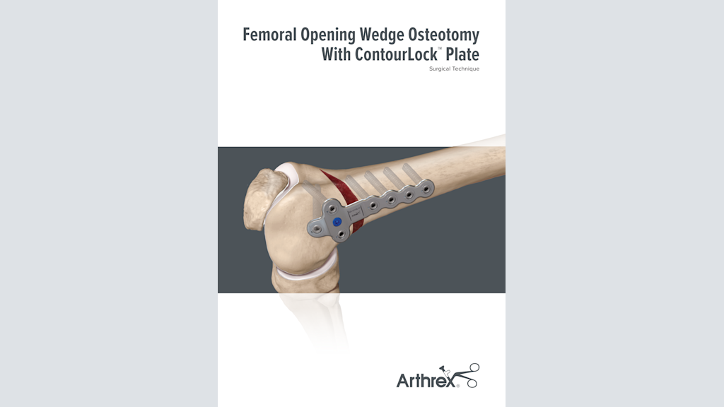 Femoral Opening Wedge Osteotomy With ContourLock™ Plate