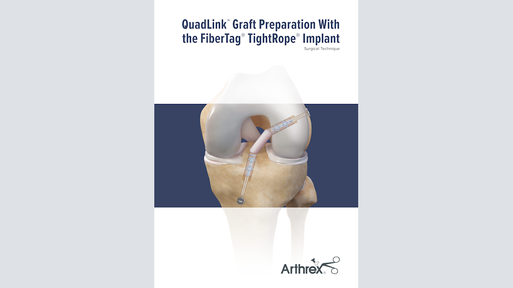 QuadLink™ Graft Preparation With the FiberTag® TightRope® Implant