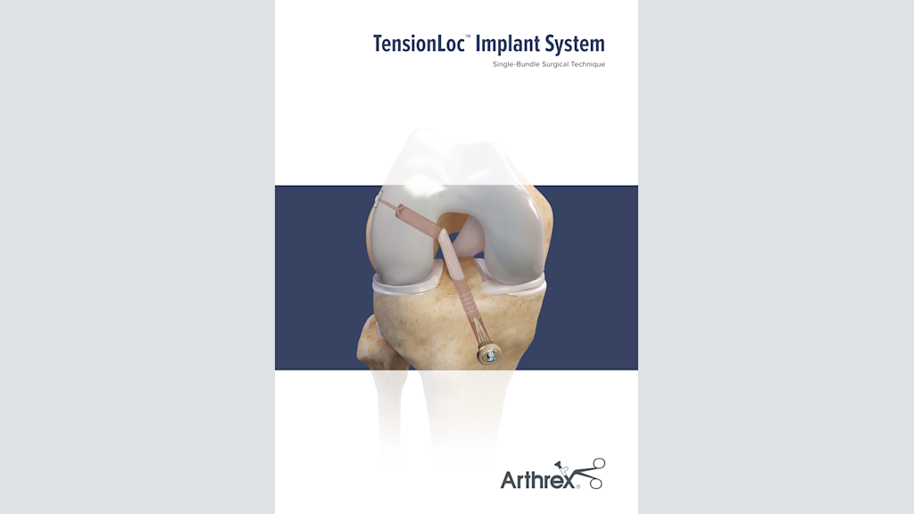 TensionLoc™ Implant System Single-Bundle Surgical Technique