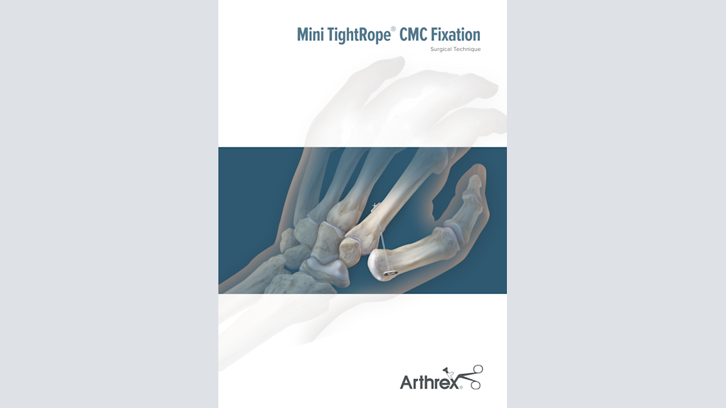 Mini TightRope® CMC Fixation